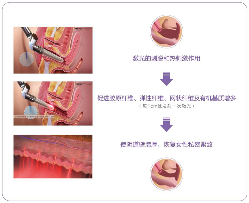 阴道松弛很要“紧”！菲蜜丽私密激光帮你做回小女人！(图8)